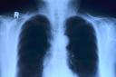 A chest X-ray ordered by George's GP revealed a shadow on one lung. (Photo: Pixabay)