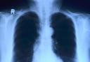 A chest X-ray ordered by George's GP revealed a shadow on one lung. (Photo: Pixabay)